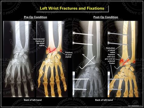 cnc machine wrist fracture|left wrist fracture.